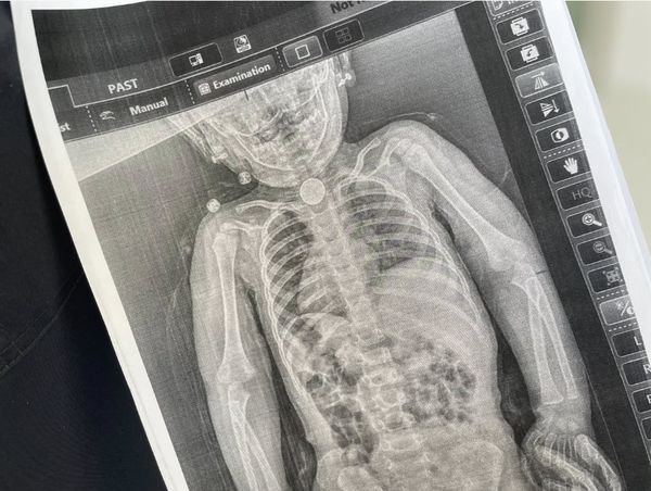 У Львові врятовано дитину, яка три місяці жила з батарейкою у стравоході (світлини) 5