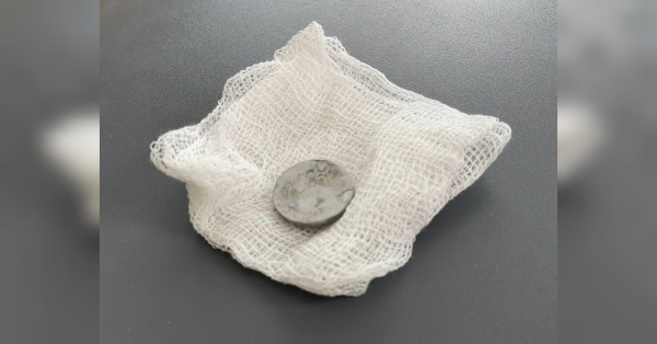 У Львові врятовано дитину, яка три місяці жила з батарейкою у стравоході&hellip;