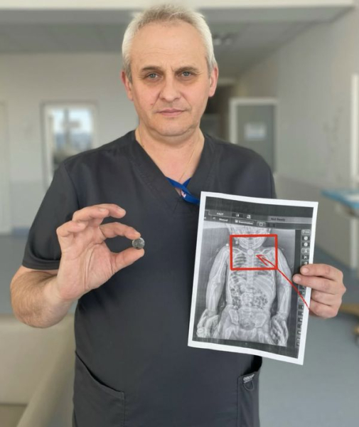 У Львові врятовано дитину, яка три місяці жила з батарейкою у стравоході (світлини) 6