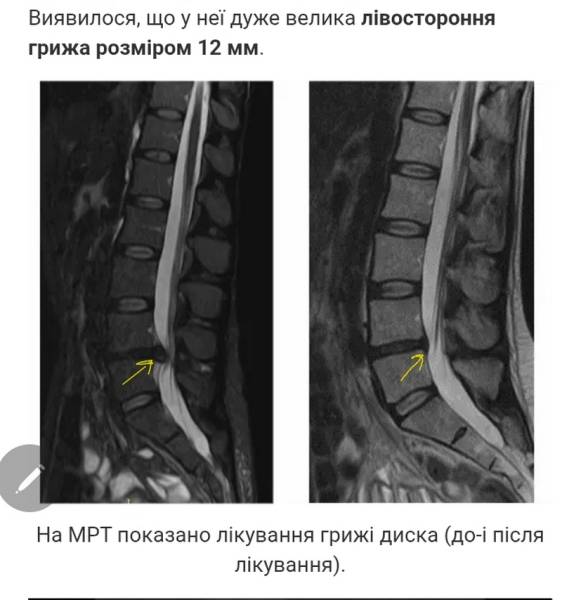 98% пацієнтів із грижею міжхребцевого диска позбулися болю без операції